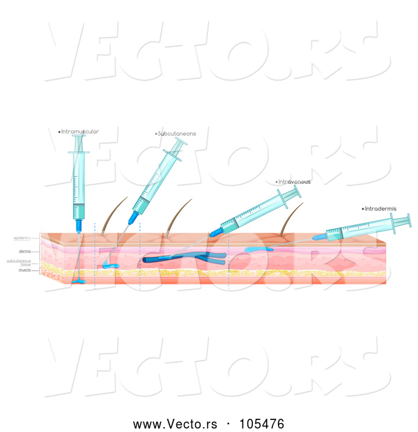 Vector of Diagram of Needles and Skin Showing Different Types of Injections