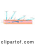 Vector of Diagram of Needles and Skin Showing Different Types of Injections by